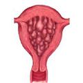 Гиперплазия эндометрия: особенности лечения разрастания слизистой оболочки матки