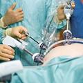 Оперативная лапароскопия при кистах и кистомах яичника