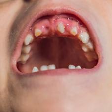 Анатомические патологии зубов