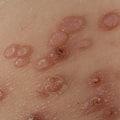 Контагиозный моллюск: особенности вирусного заболевания кожи
