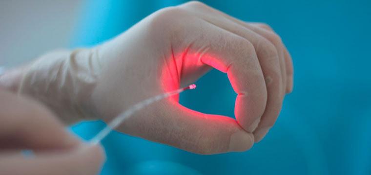 Лазерное лечение варикозного расширения вен