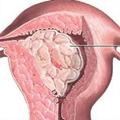 железистая гиперплазия эндометрия