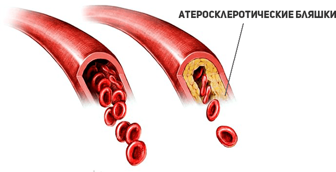 атеросклероз сосудов