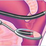 adenoid11.jpg