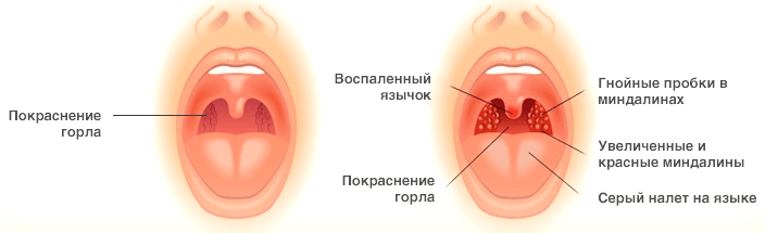 признаки ангины признаки ангины