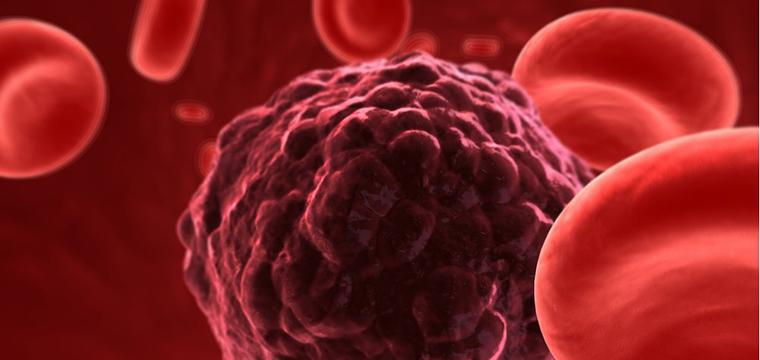 Гемохроматоз: все, что нужно знать о нарушениях обмена железа в организме