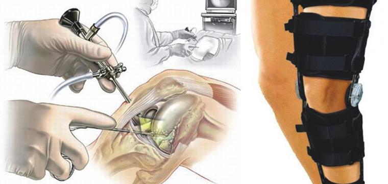 Артроскопия коленного сустава: особенности операции