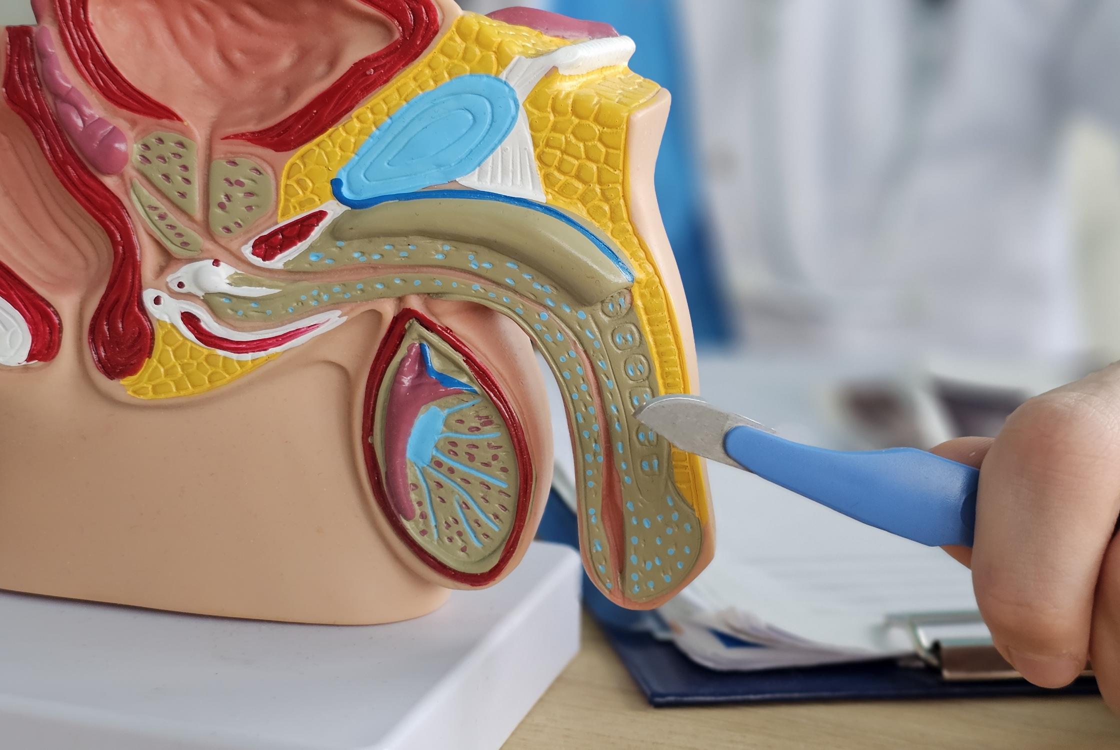 Визуализация раздела Кавернит: симптомы и лечение заболевания кавернозных тел полового члена