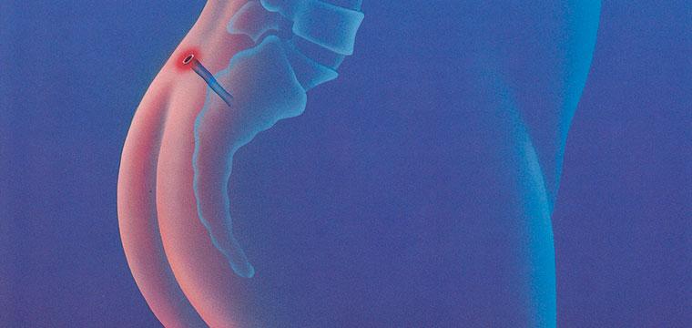 Визуализация раздела Эпителиальный копчиковый ход