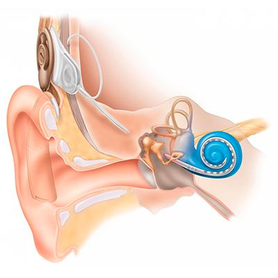 Кохлеарная имплантация: особенности внутреннего уха