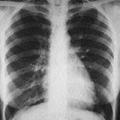 Рентген грудной клетки: особенности флюорографии