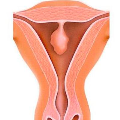 Полипы эндометрия: особенности доброкачественного разрастания слизистой матки