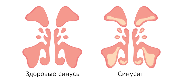 синусит синусит