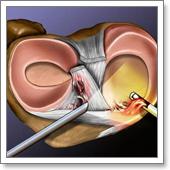 артроскопия коленного сустава