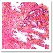 гистология рака предстательной железы